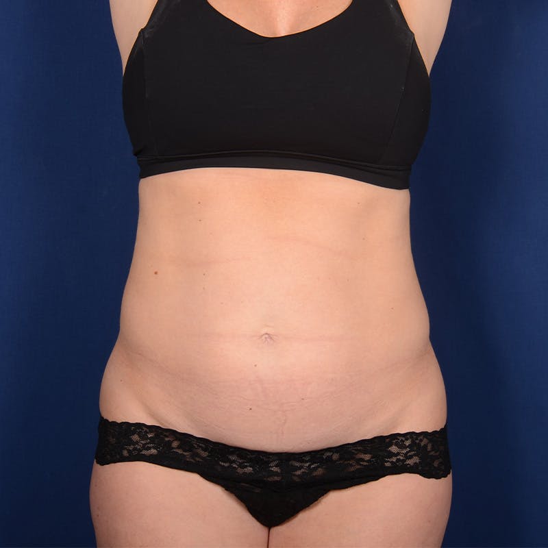 Tummy Tuck Before & After Gallery - Patient 201916 - Image 1