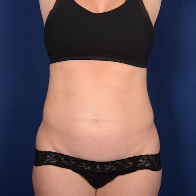 Tummy Tuck Before & After Gallery - Patient 201916 - Image 1