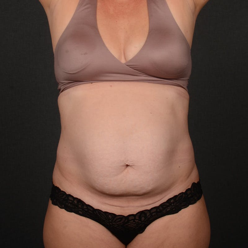 Tummy Tuck Before & After Gallery - Patient 230155 - Image 1