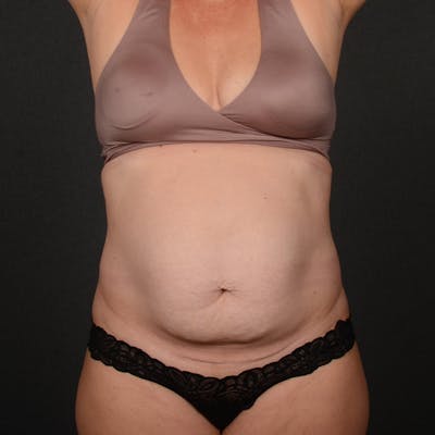 Tummy Tuck Before & After Gallery - Patient 230155 - Image 1