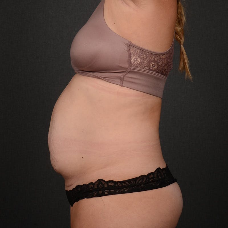 Tummy Tuck Before & After Gallery - Patient 230155 - Image 5