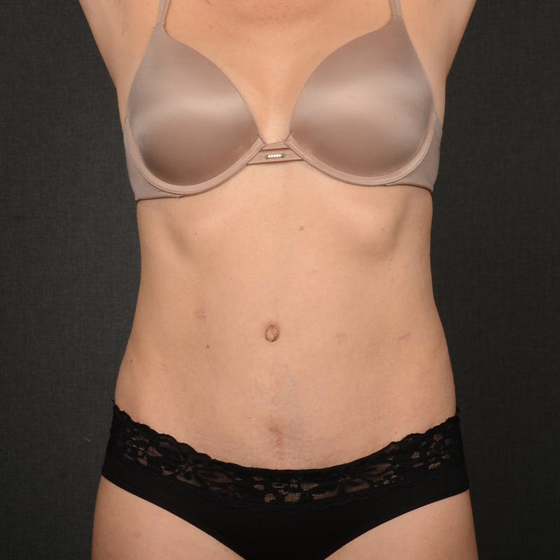 Tummy Tuck Before & After Gallery - Patient 398779 - Image 2