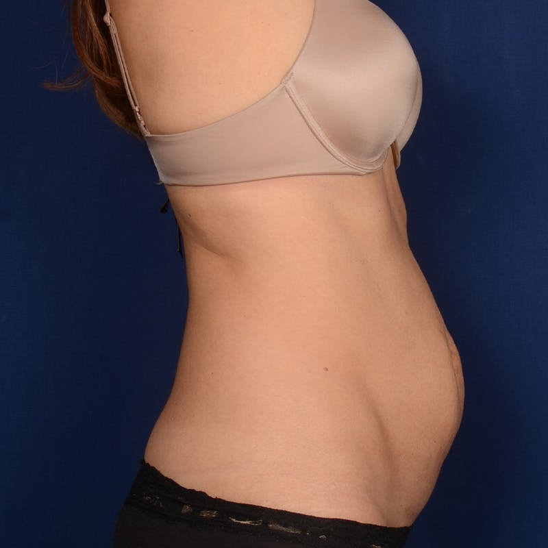 Tummy Tuck Before & After Gallery - Patient 398779 - Image 5