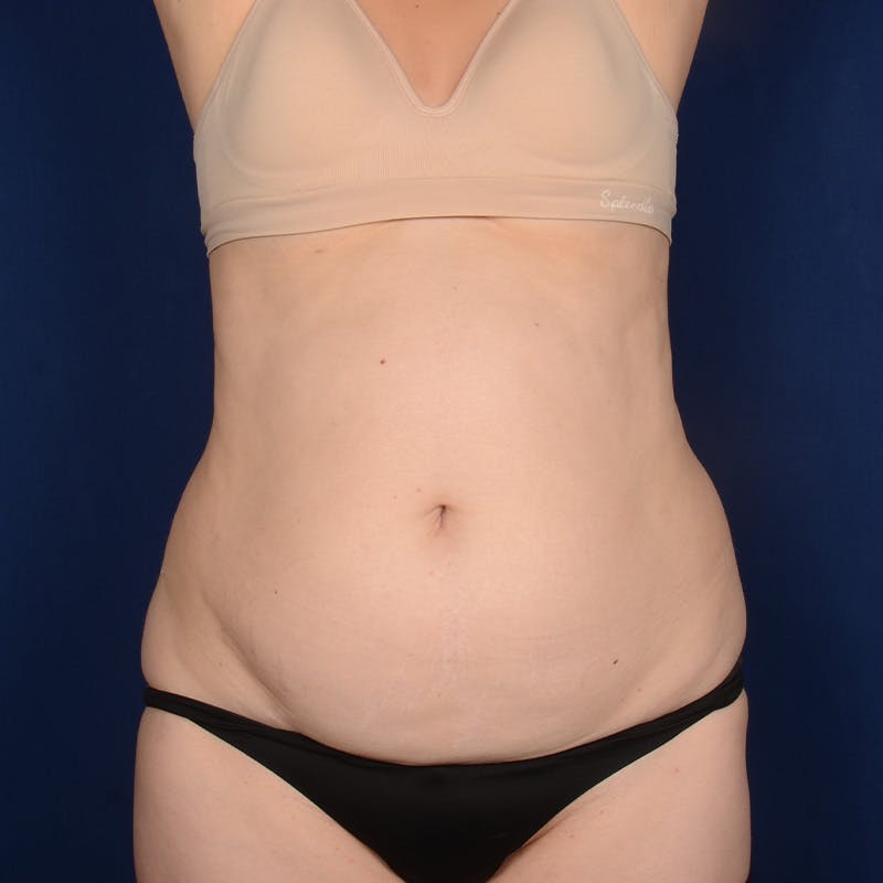 Tummy Tuck Before & After Gallery - Patient 261196 - Image 1