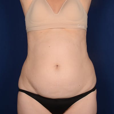 Tummy Tuck Before & After Gallery - Patient 261196 - Image 1