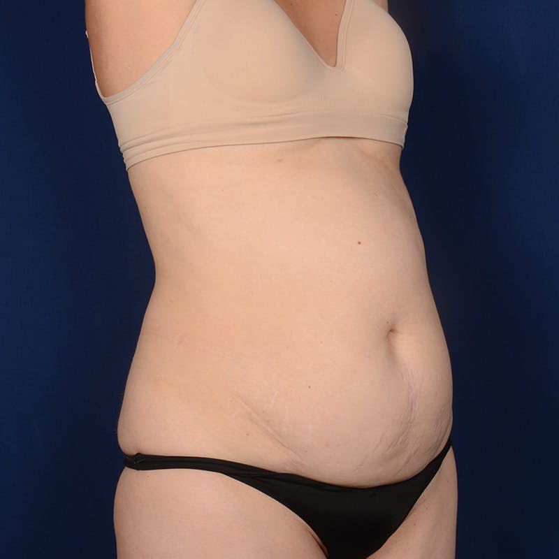 Tummy Tuck Before & After Gallery - Patient 261196 - Image 3