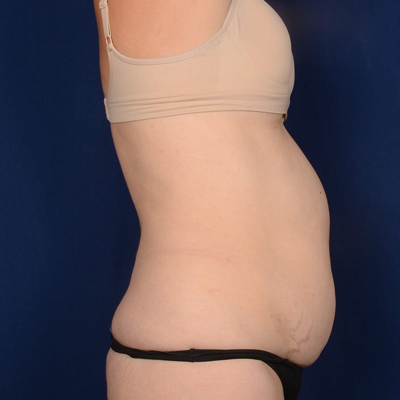 Tummy Tuck Before & After Gallery - Patient 261196 - Image 5