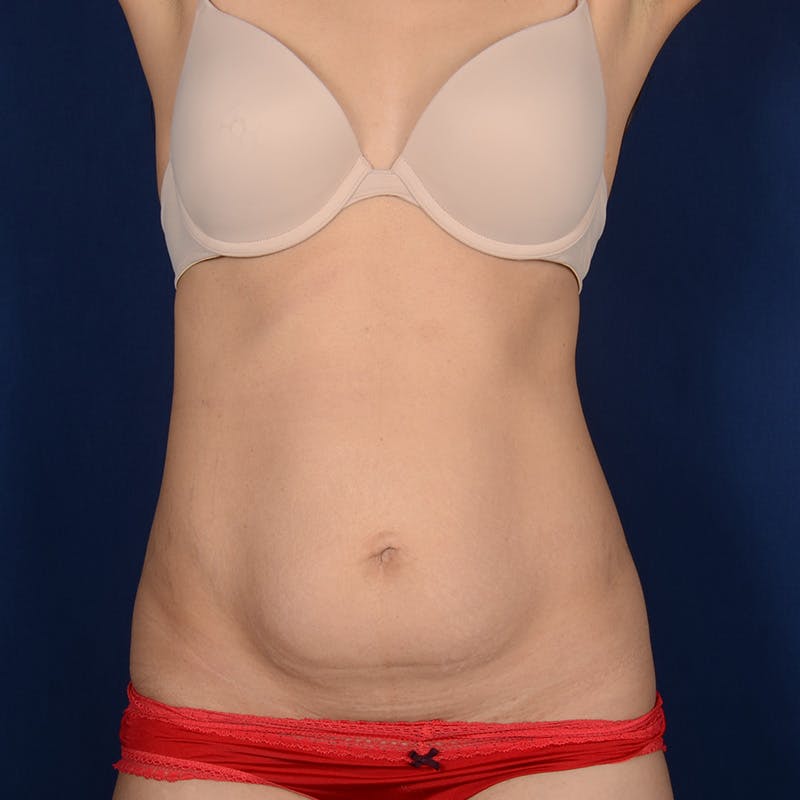 Tummy Tuck Before & After Gallery - Patient 155524 - Image 1