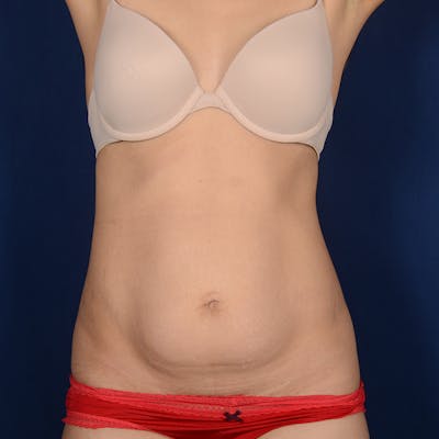 Tummy Tuck Before & After Gallery - Patient 155524 - Image 1