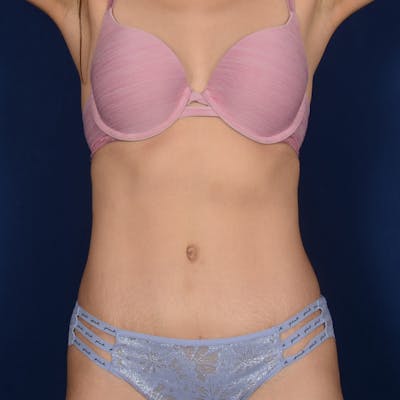 Tummy Tuck Before & After Gallery - Patient 155524 - Image 2