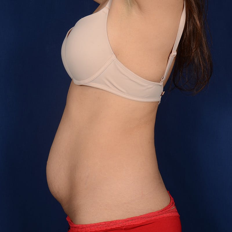 Tummy Tuck Before & After Gallery - Patient 155524 - Image 5