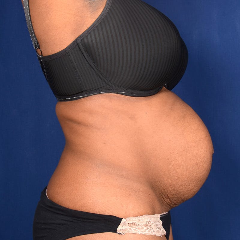 Tummy Tuck Before & After Gallery - Patient 218021 - Image 5