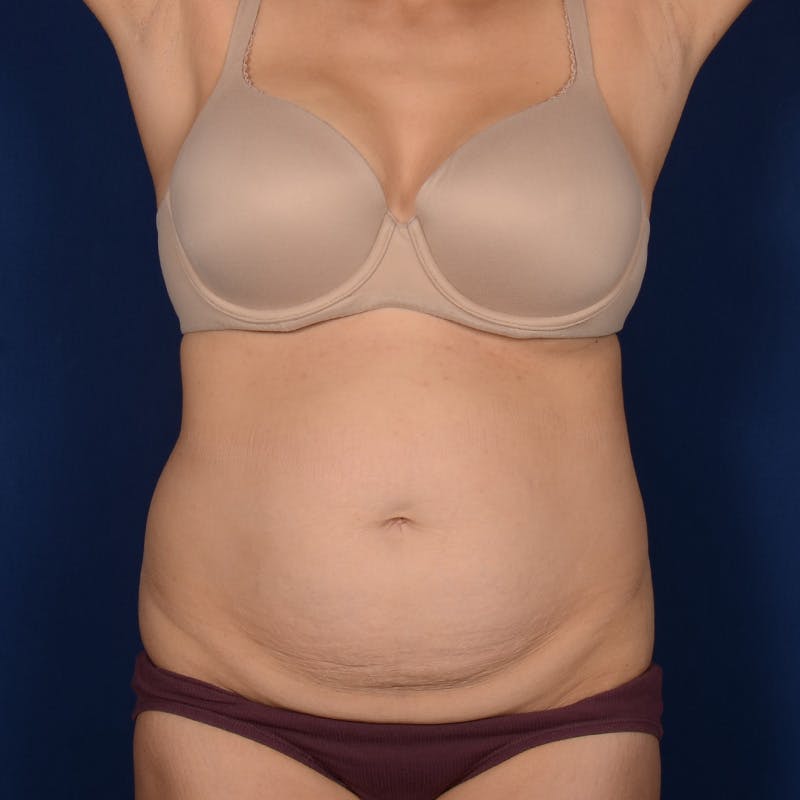 Tummy Tuck Before & After Gallery - Patient 170977 - Image 1