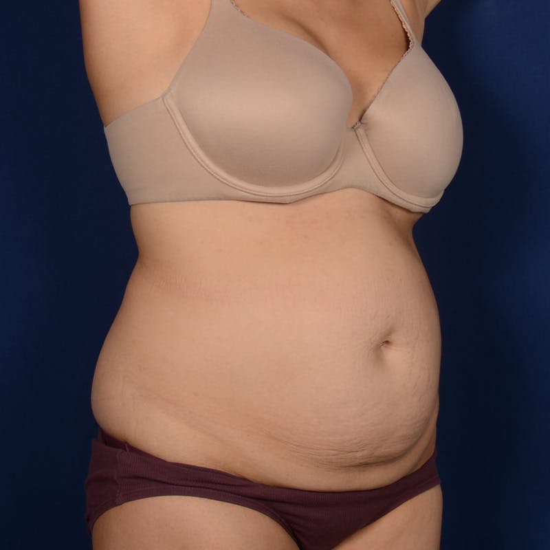 Tummy Tuck Before & After Gallery - Patient 170977 - Image 3
