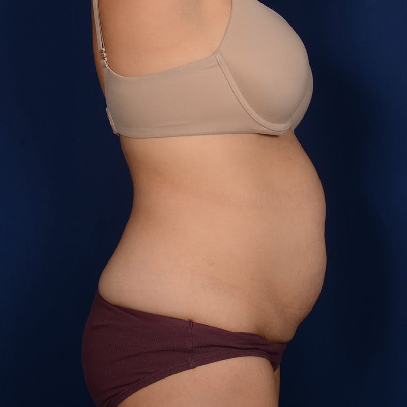 Tummy Tuck Before & After Gallery - Patient 170977 - Image 5