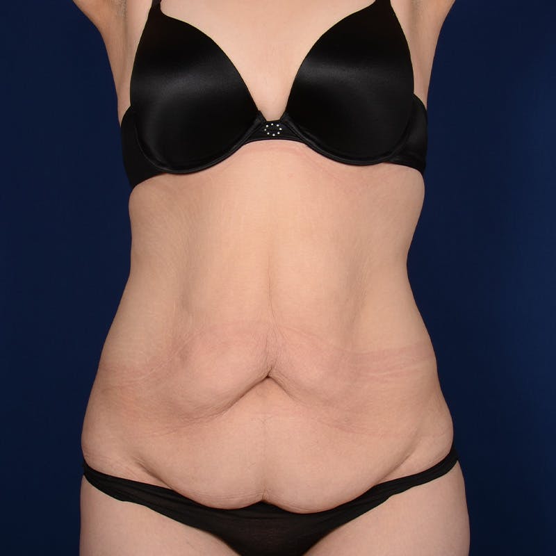 Tummy Tuck Before & After Gallery - Patient 266464 - Image 1