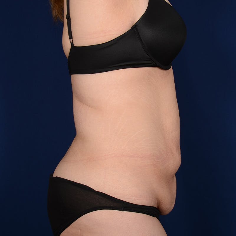 Tummy Tuck Before & After Gallery - Patient 266464 - Image 5