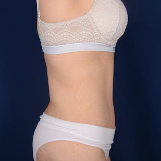 Tummy Tuck Before & After Gallery - Patient 266464 - Image 6