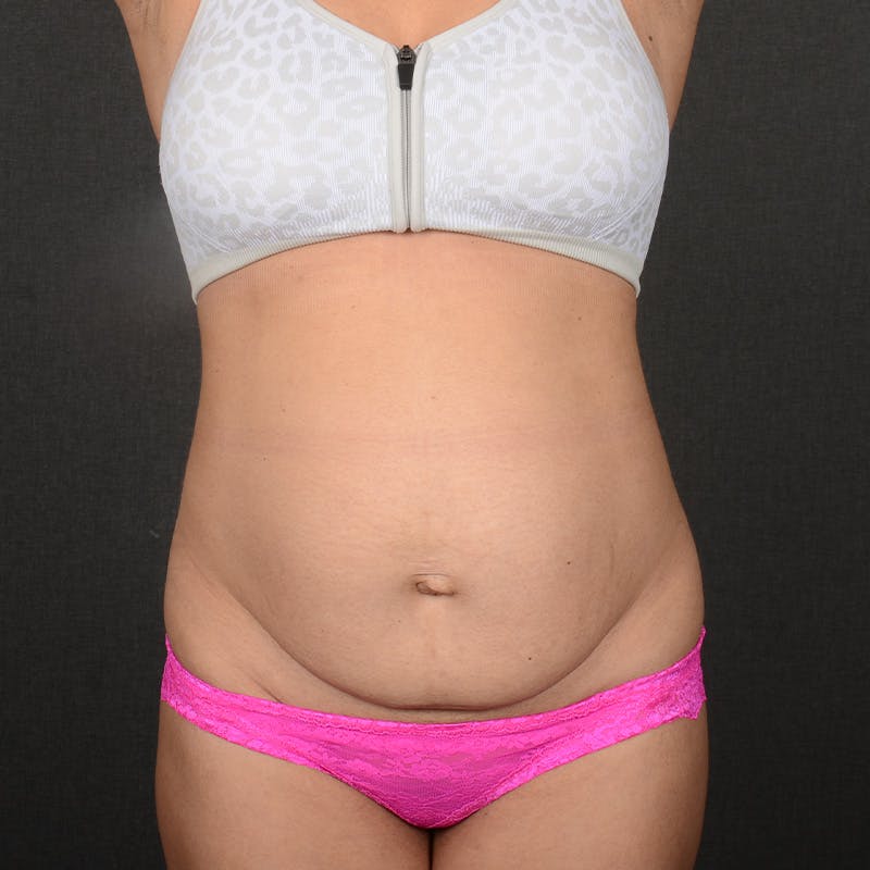 Tummy Tuck Before & After Gallery - Patient 641527 - Image 1