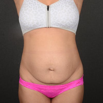 Tummy Tuck Before & After Gallery - Patient 641527 - Image 1