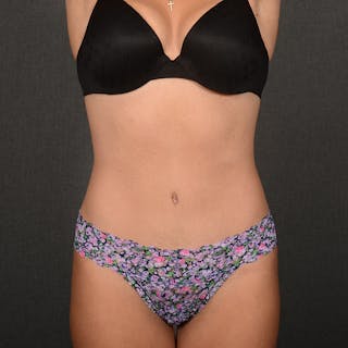 Tummy Tuck Before & After Gallery - Patient 641527 - Image 2