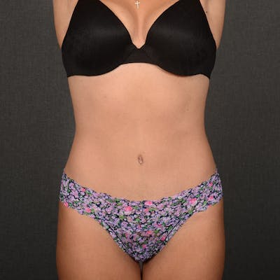 Tummy Tuck Before & After Gallery - Patient 641527 - Image 2