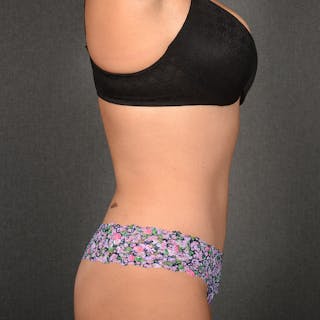 Tummy Tuck Before & After Gallery - Patient 641527 - Image 6