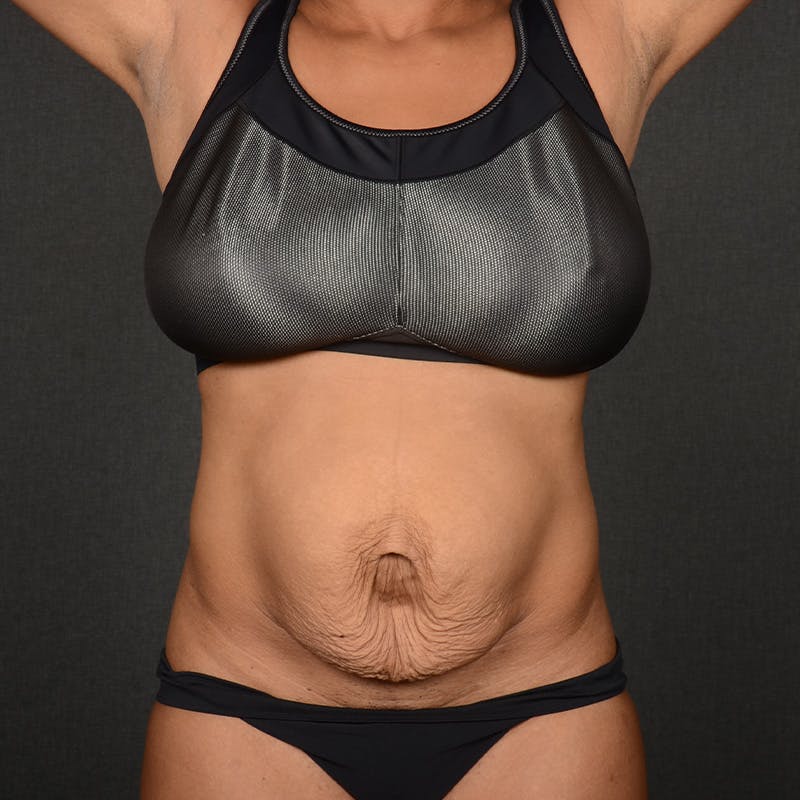 Tummy Tuck Before & After Gallery - Patient 390894 - Image 1