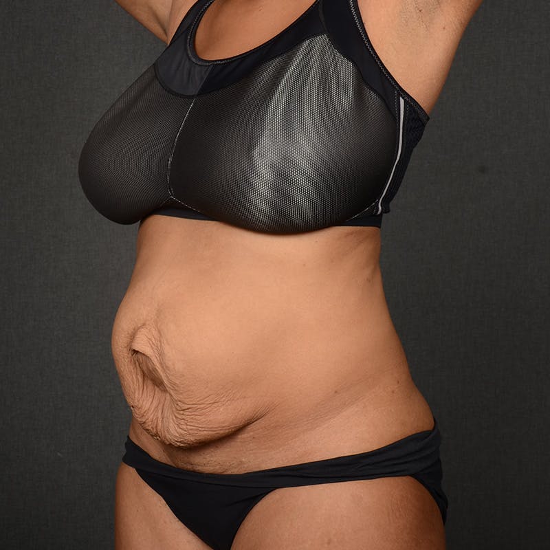 Tummy Tuck Before & After Gallery - Patient 390894 - Image 3