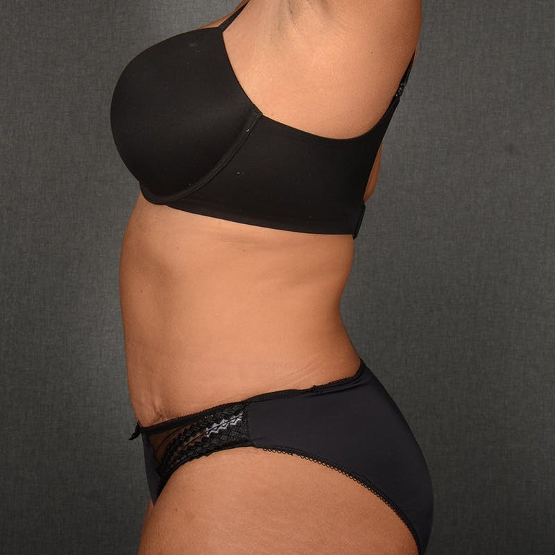 Tummy Tuck Before & After Gallery - Patient 390894 - Image 6