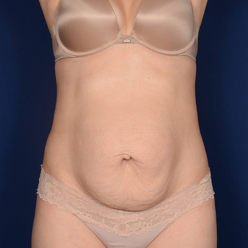Tummy Tuck Before & After Gallery - Patient 332158 - Image 1