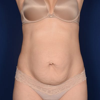 Tummy Tuck Before & After Gallery - Patient 332158 - Image 1