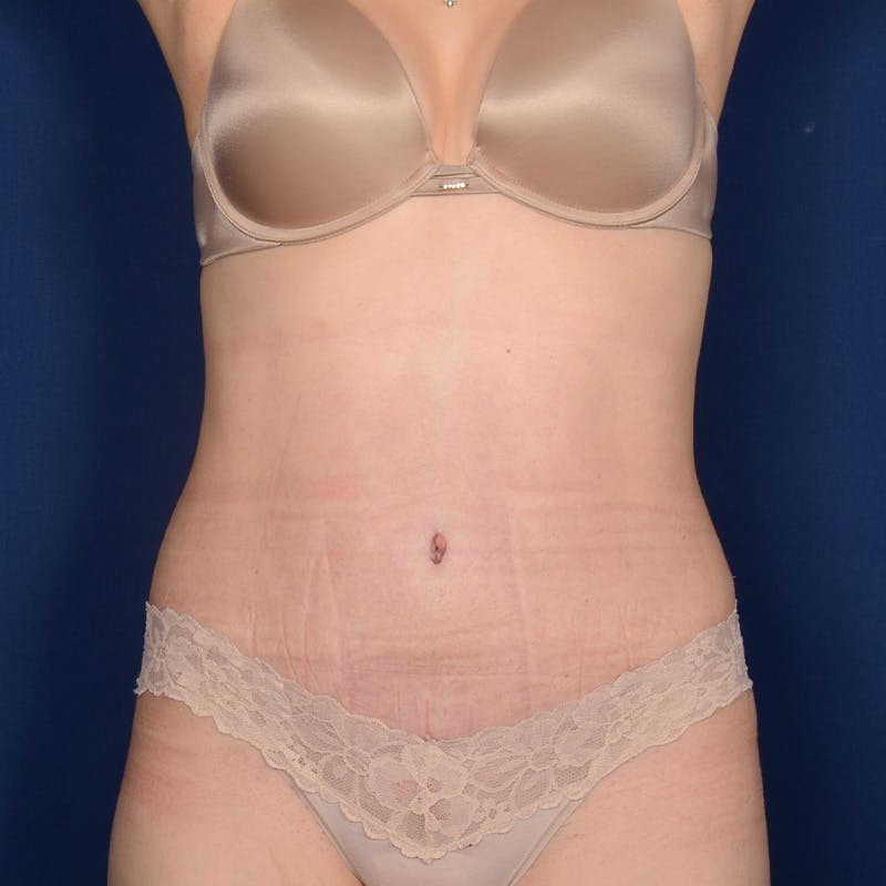 Tummy Tuck Before & After Gallery - Patient 332158 - Image 2