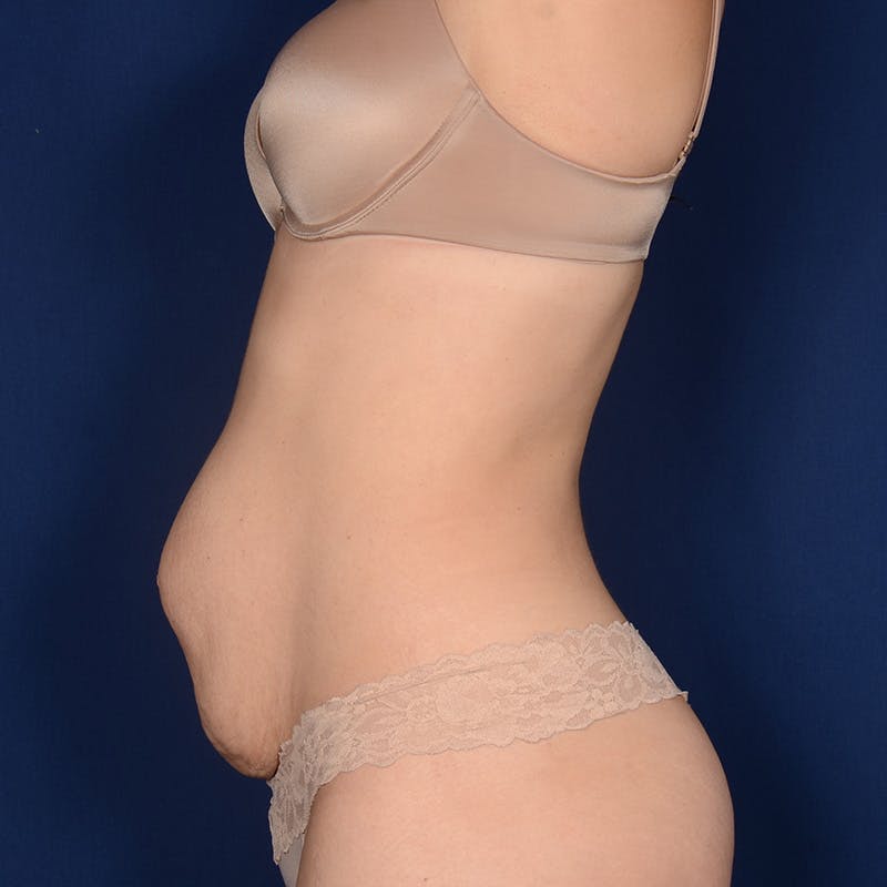 Tummy Tuck Before & After Gallery - Patient 332158 - Image 5