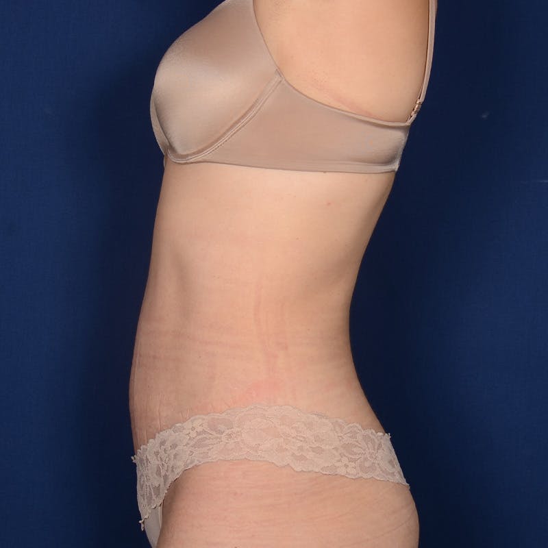 Tummy Tuck Before & After Gallery - Patient 332158 - Image 6