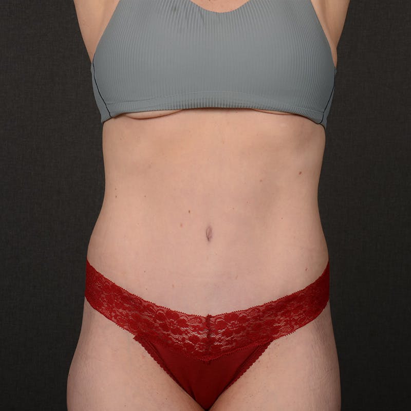 Tummy Tuck Before & After Gallery - Patient 359890 - Image 2