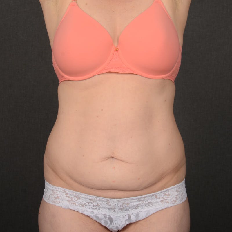 Tummy Tuck Before & After Gallery - Patient 359890 - Image 1