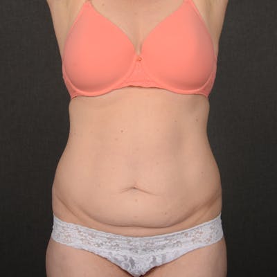 Tummy Tuck Before & After Gallery - Patient 359890 - Image 1