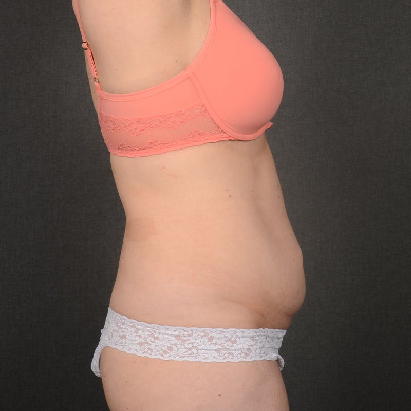 Tummy Tuck Before & After Gallery - Patient 359890 - Image 5