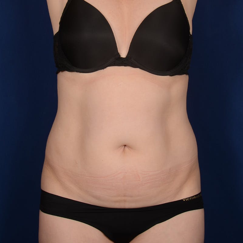 Tummy Tuck Before & After Gallery - Patient 515618 - Image 1