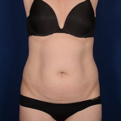 Tummy Tuck Before & After Gallery - Patient 515618 - Image 1