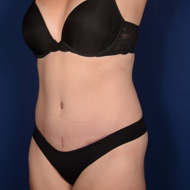 Tummy Tuck Before & After Gallery - Patient 515618 - Image 4