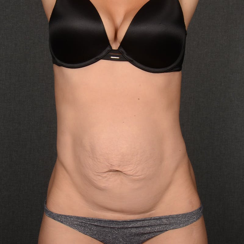 Tummy Tuck Before & After Gallery - Patient 617375 - Image 1