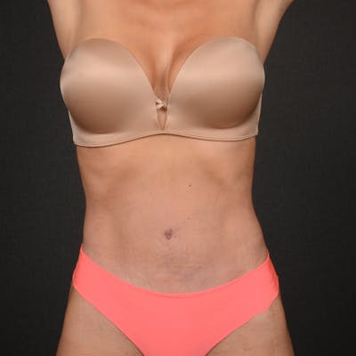 Tummy Tuck Before & After Gallery - Patient 617375 - Image 2
