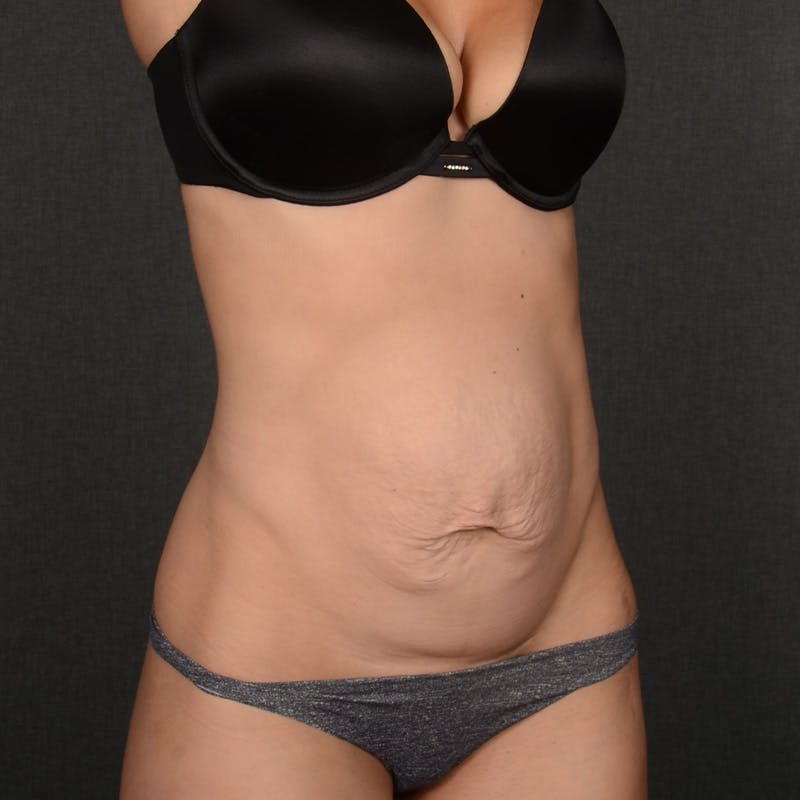 Tummy Tuck Before & After Gallery - Patient 617375 - Image 3