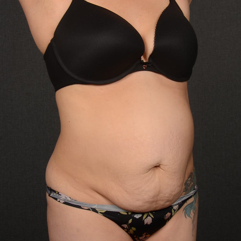 Tummy Tuck Before & After Gallery - Patient 162438 - Image 3