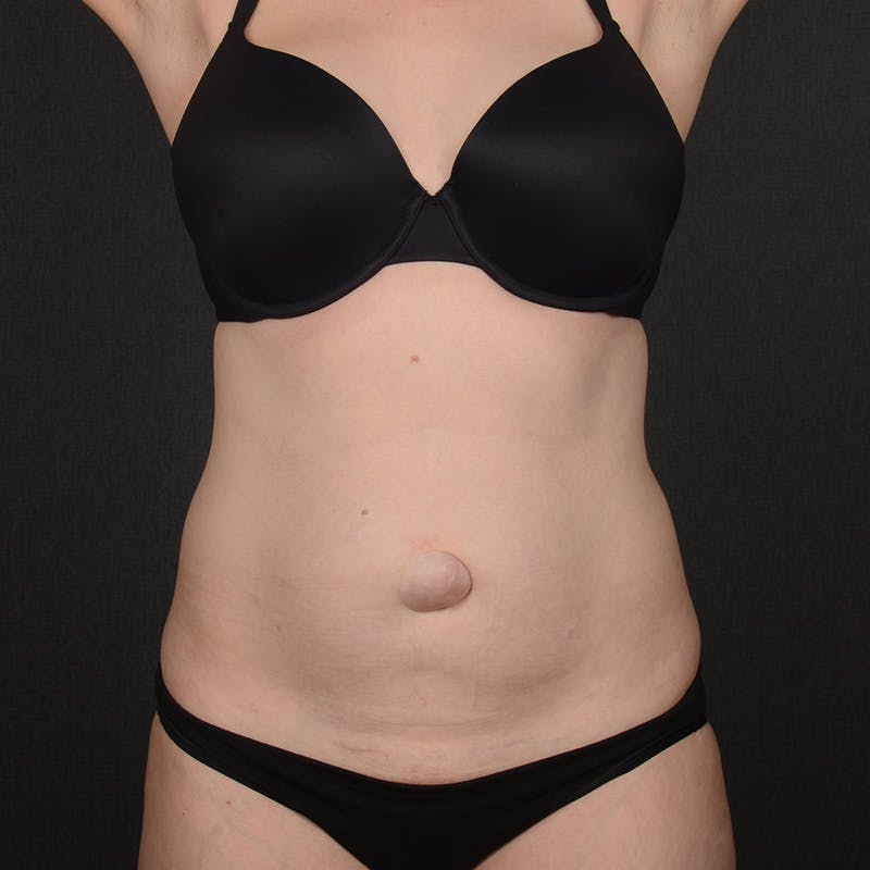 Tummy Tuck Before & After Gallery - Patient 860421 - Image 1