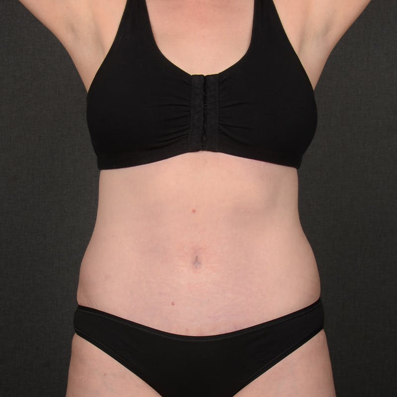 Tummy Tuck Before & After Gallery - Patient 860421 - Image 2