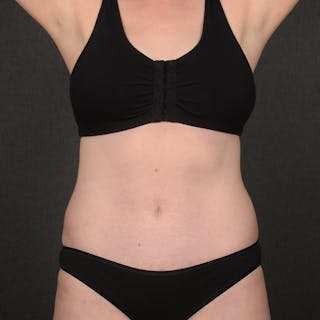 Tummy Tuck Before & After Gallery - Patient 860421 - Image 2