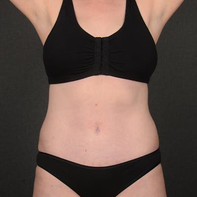 Tummy Tuck Before & After Gallery - Patient 860421 - Image 2